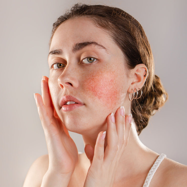 Skin Concerns - Redness