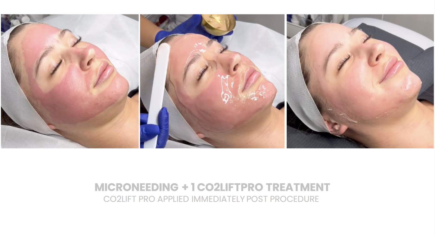 CO2Lift Pro Topical Carboxy – 1 Treatment Box