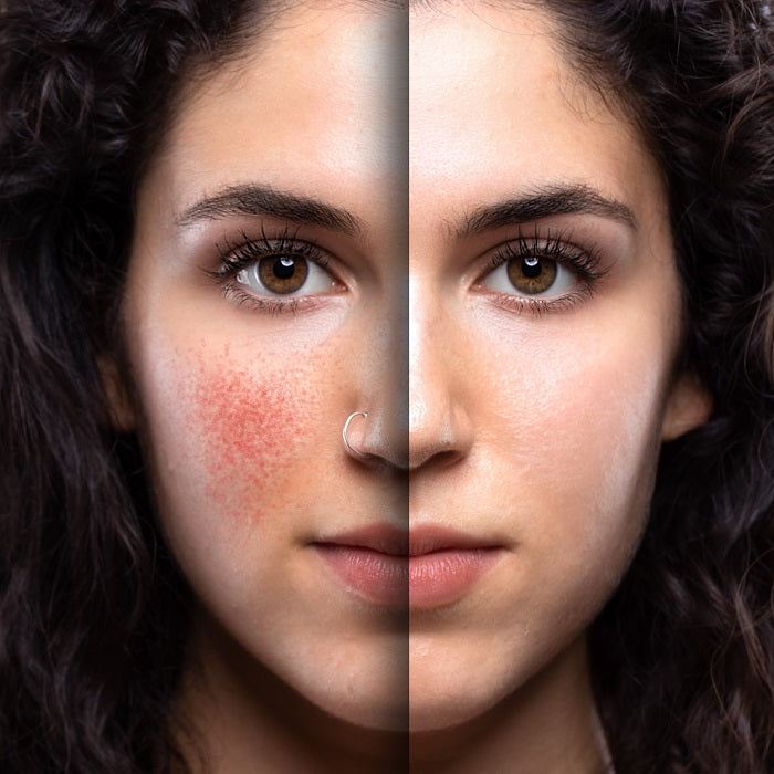 Rosacea Awareness Month: Skincare Superheroes for Your Redness and Flare-Ups