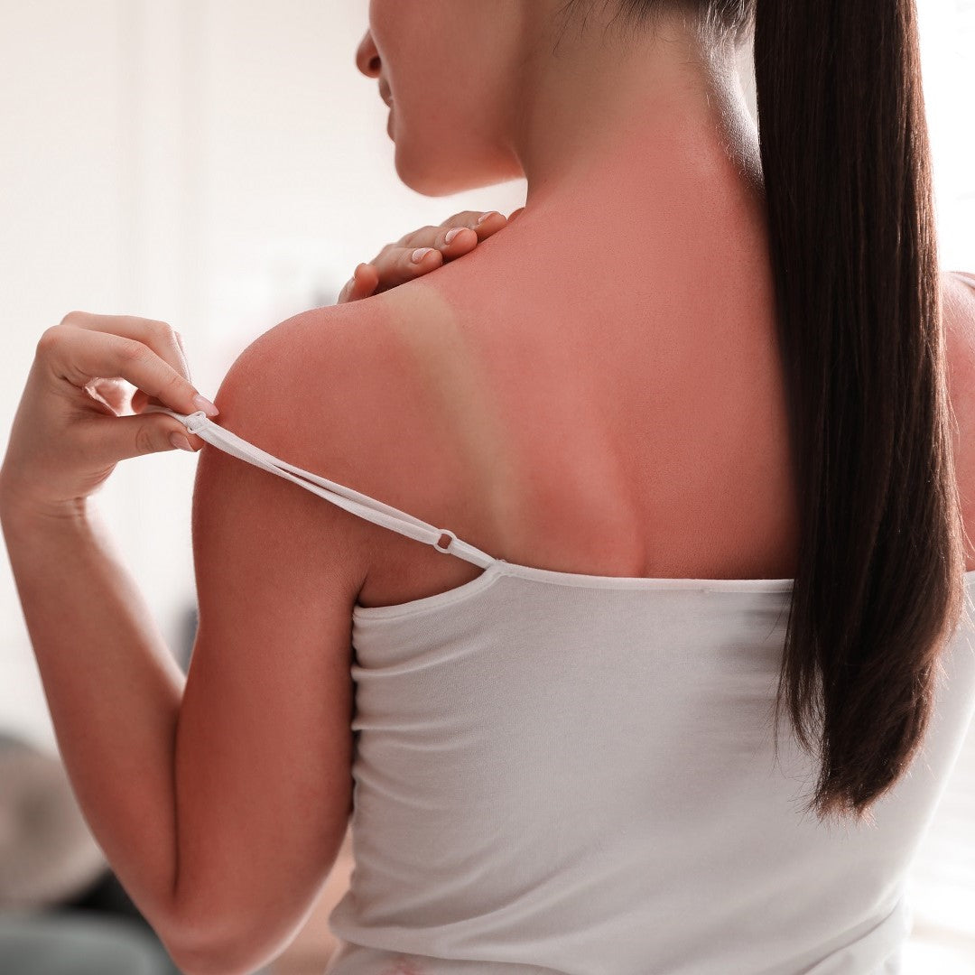 Tips For Treating and Preventing Sunburn